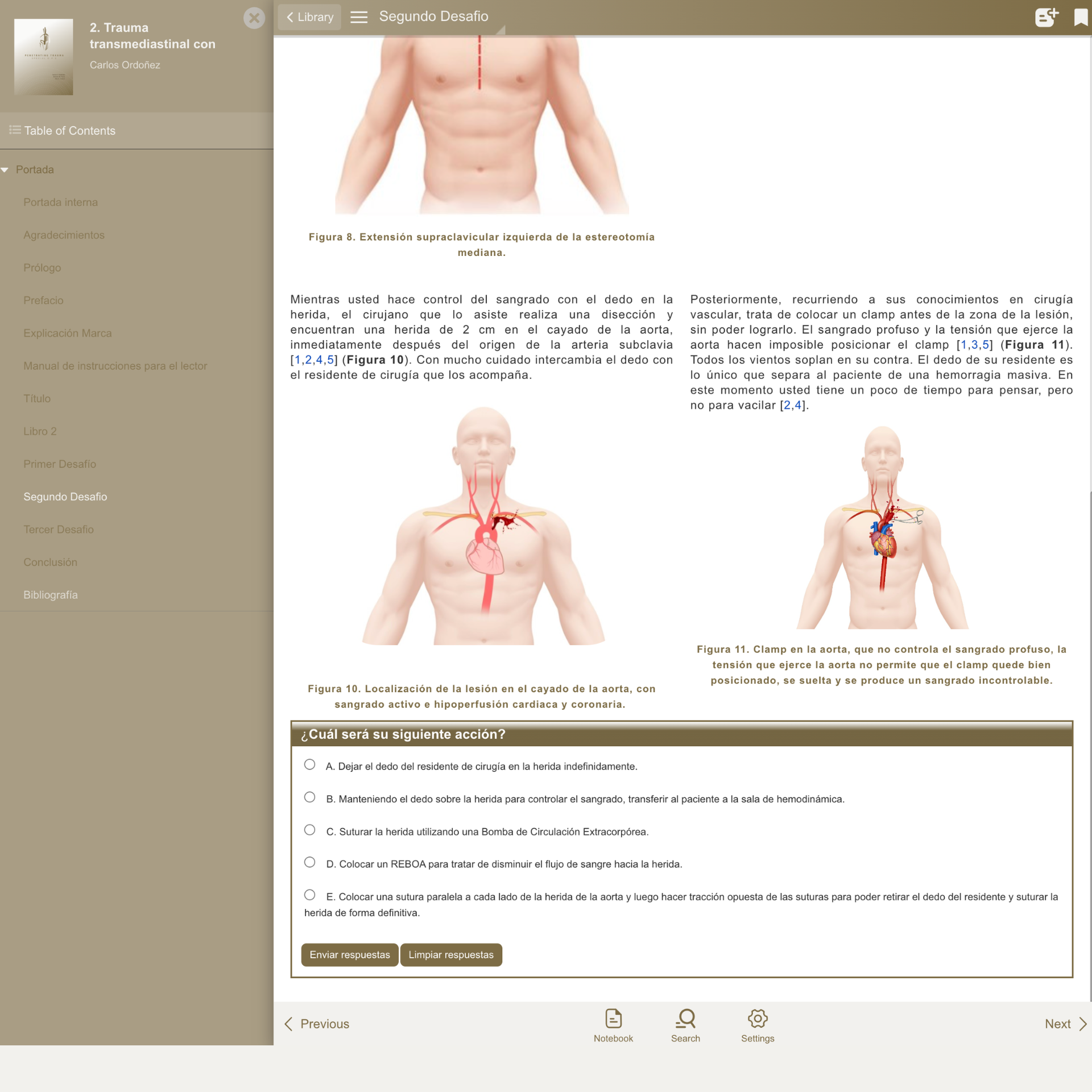 Caso 2: Trauma transmediastinal con lesión del arco aórtico
